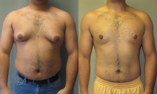 Smiling patients sharing their gynecomastia surgery experiences in Malappuram