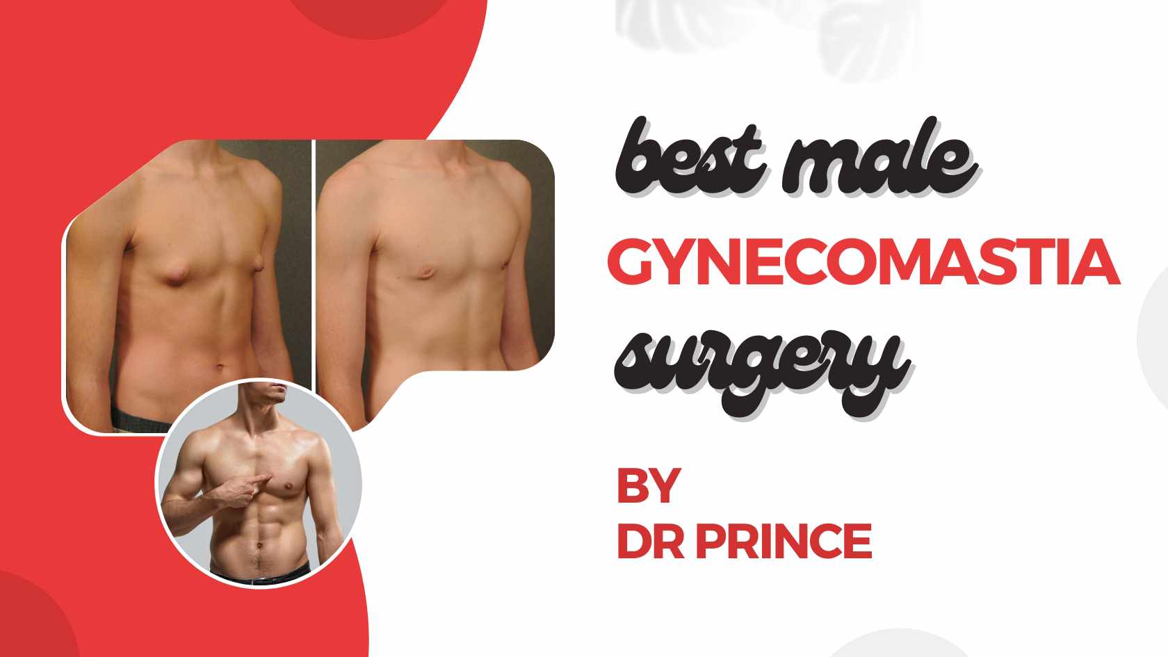 Illustration of a male figure with a before and after depiction of gynecomastia surgery.