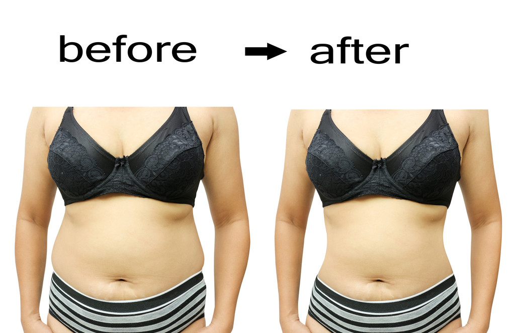 Liposuction Before and After Results in Thrissur by Dr. Prince
