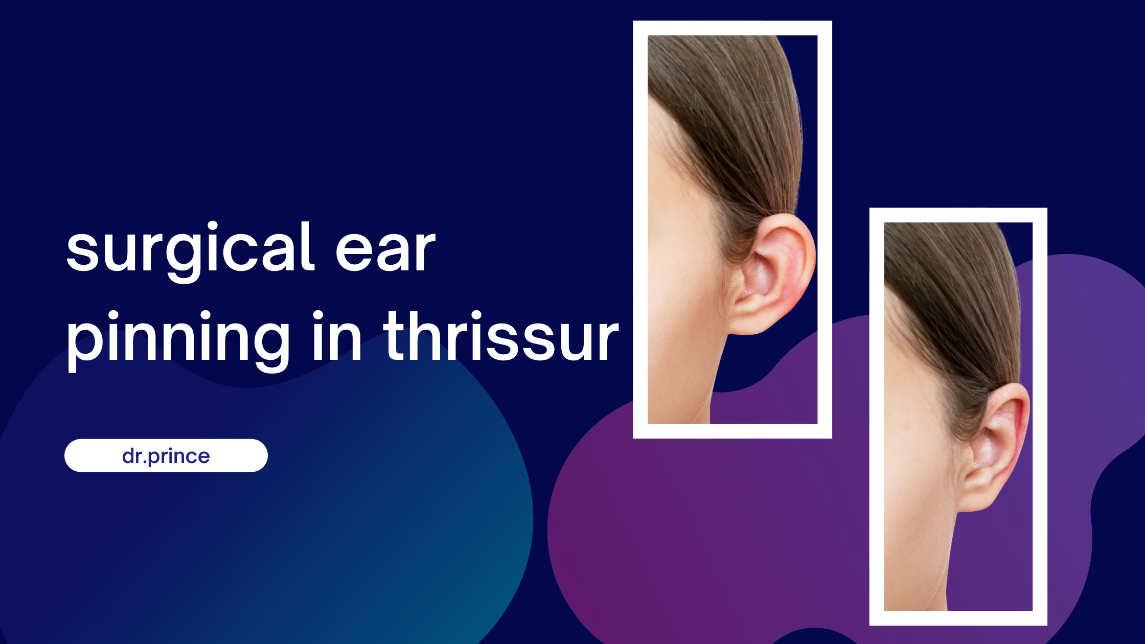 Surgical Ear Pinning in Thrissur