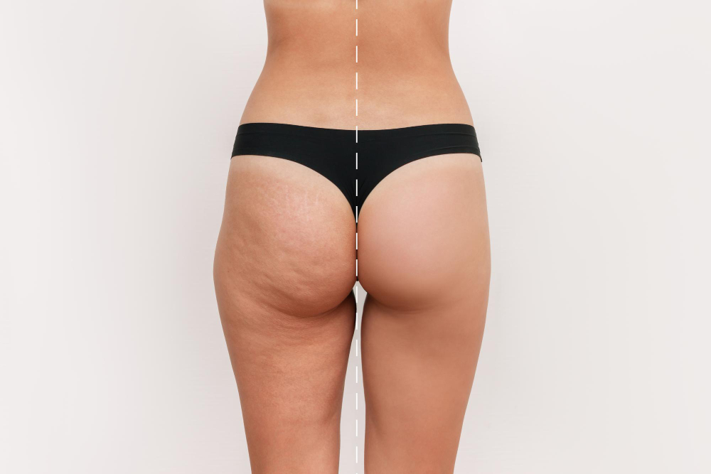 Natural-Looking Results: Butt Lift Surgery by Dr. Prince near Malappuram