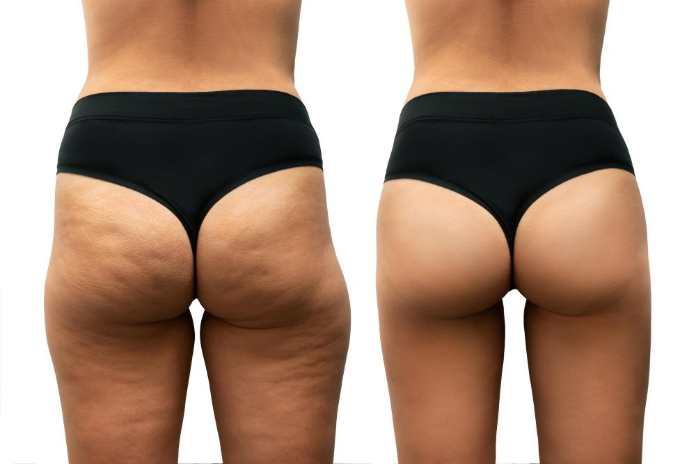 Enhance Your Silhouette with Butt Lift Surgery Solutions in Malappuram