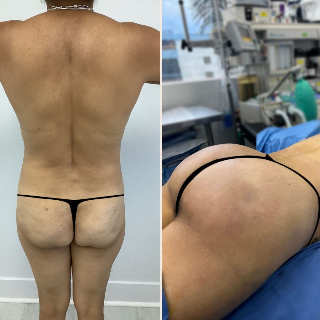 Before and after images showcasing the results of butt lift surgery at Dr. Prince's clinic in Thrissur