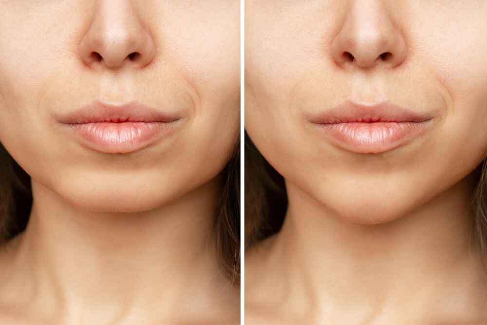 Chin implant procedure performed by Dr. Prince, a leading plastic surgeon in India.