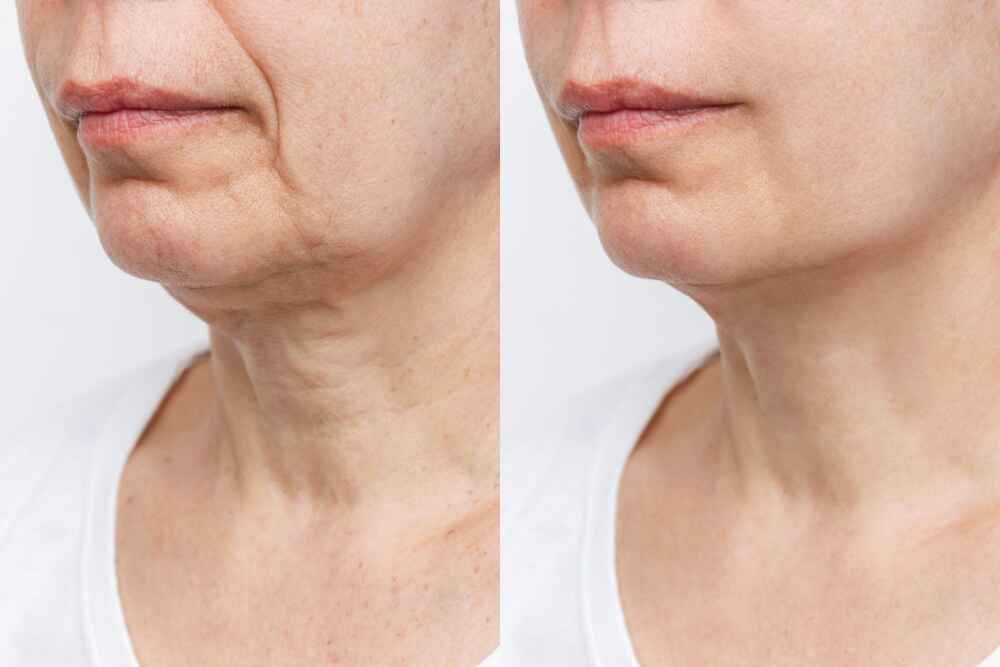Successful chin implant surgery performed by Dr. Prince, showcasing his expertise.