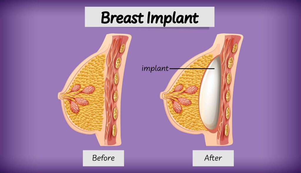 Types of Breast Implants for Surgery
