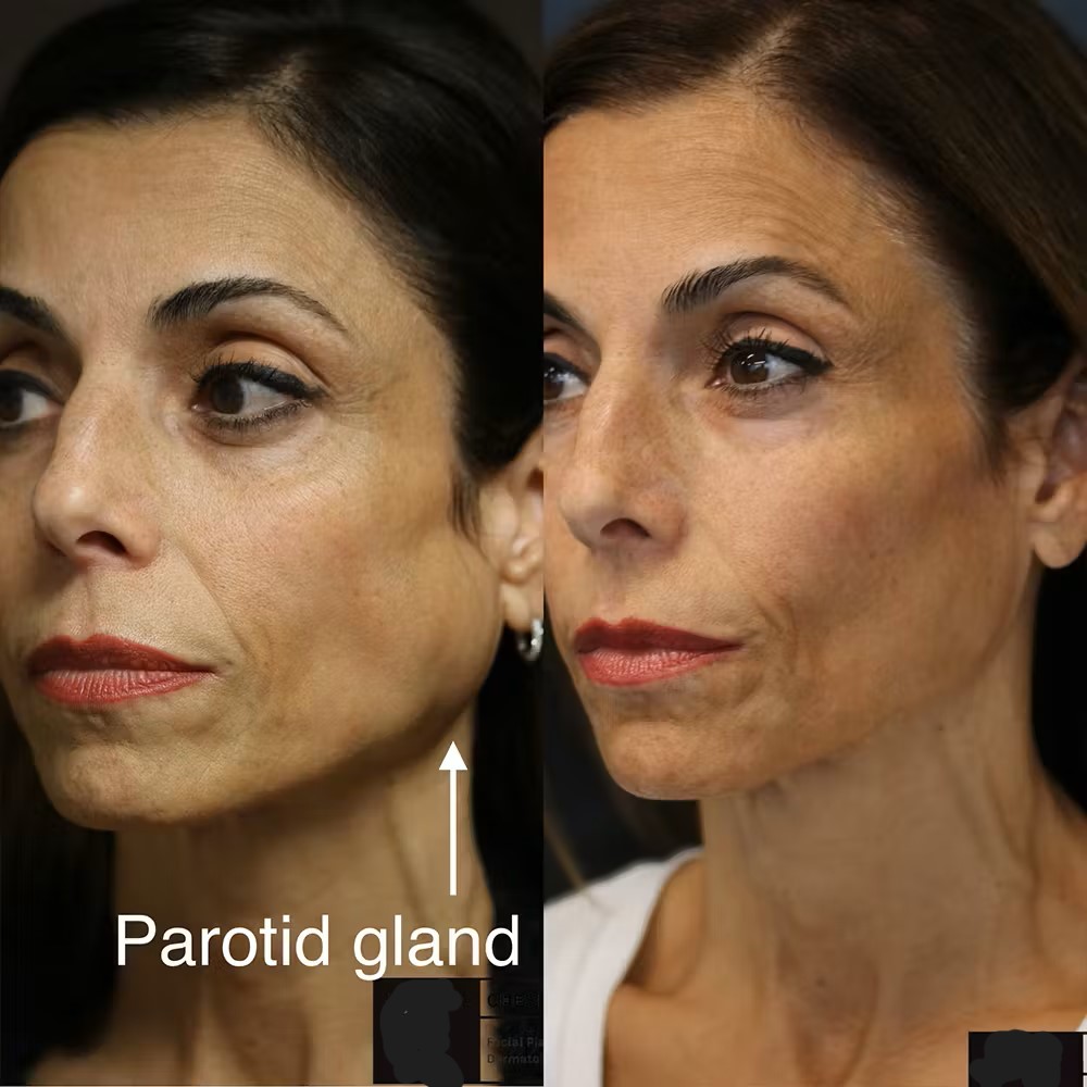 Advanced Facial Nerve Palsy Treatment by Dr. Prince