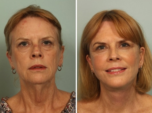 Fat grafting for facial enhancement in Thrissur by Dr. Prince