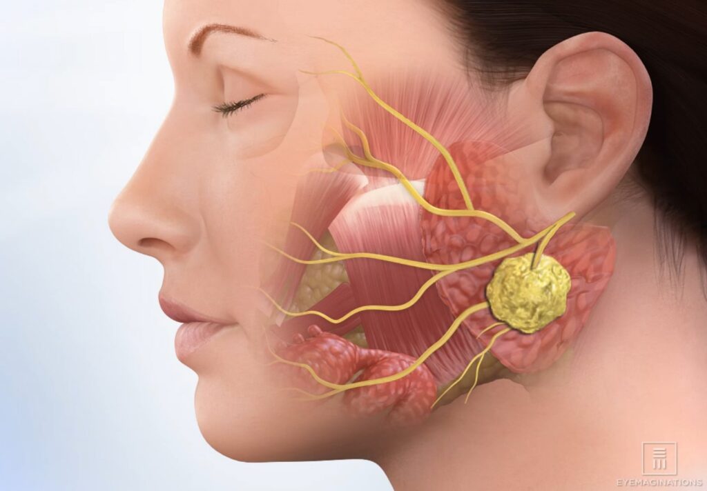 Specialist Treatment for Facial Nerve Palsy - Dr. Prince