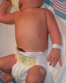 Advanced Pediatric Brachial Plexus Treatments - Dr. Prince offers cutting-edge care in Thrissur.