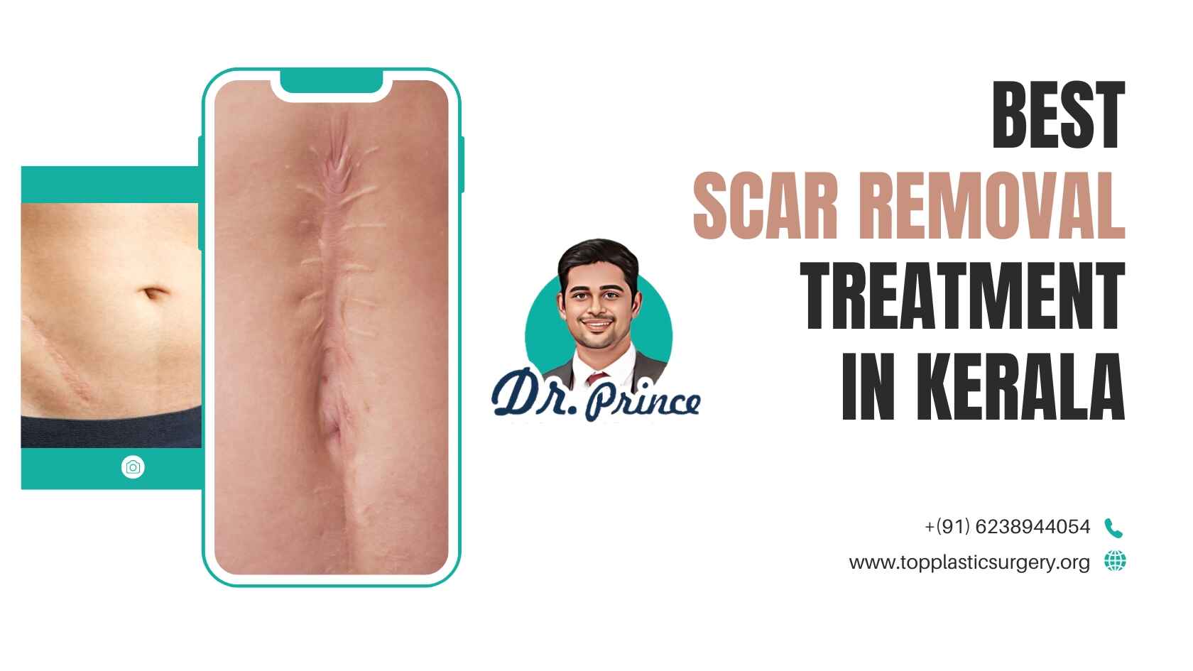 Dr. Prince performing a scar removal treatment in Kerala.