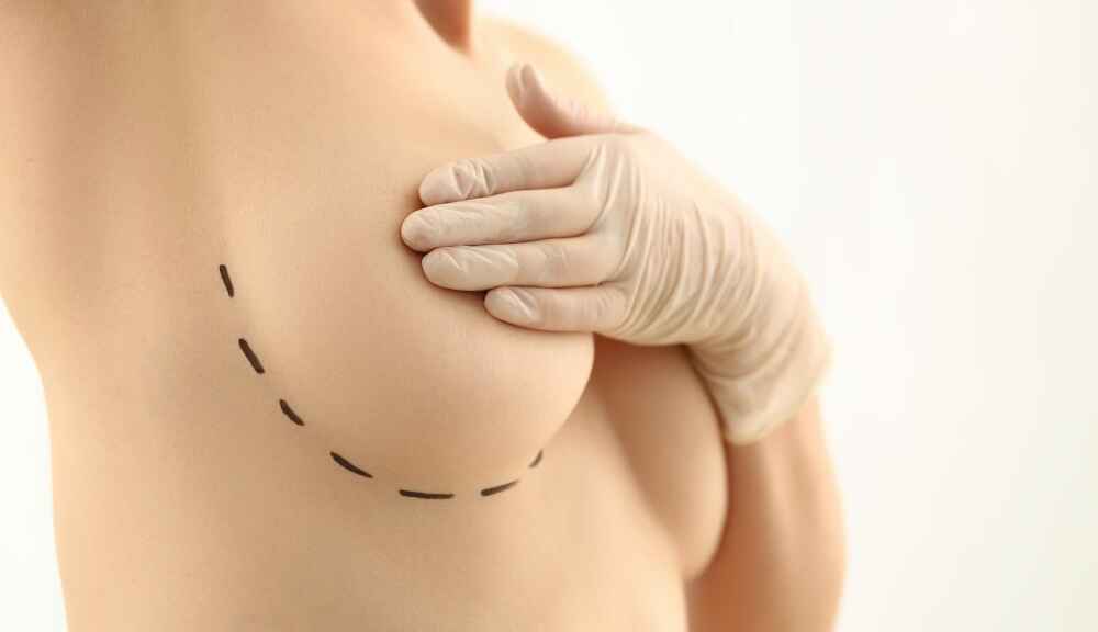 Breast Lift Surgery by Dr. Prince in Kerala