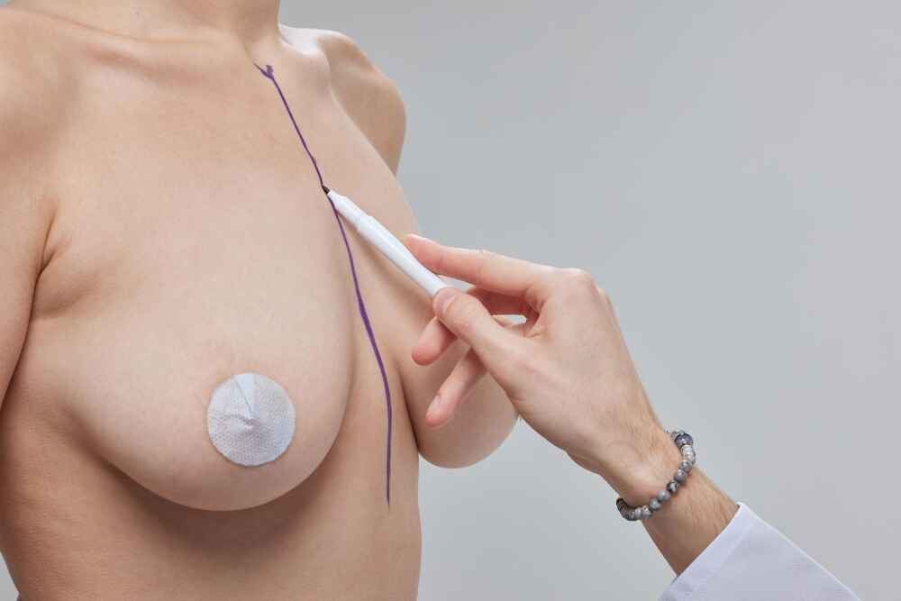 Breast Augmentation Surgery in Kerala by Dr. Prince