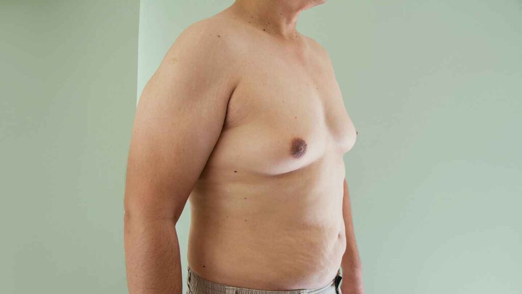 Surgeon performing gynecomastia surgery