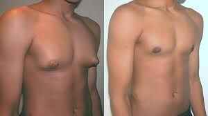 Surgeon consulting with a patient about gynecomastia treatment