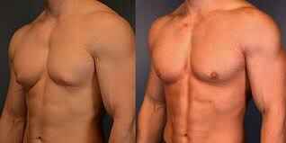 Pre-operative preparation for gynecomastia surgery