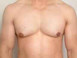 Patient resting after gynecomastia surgery