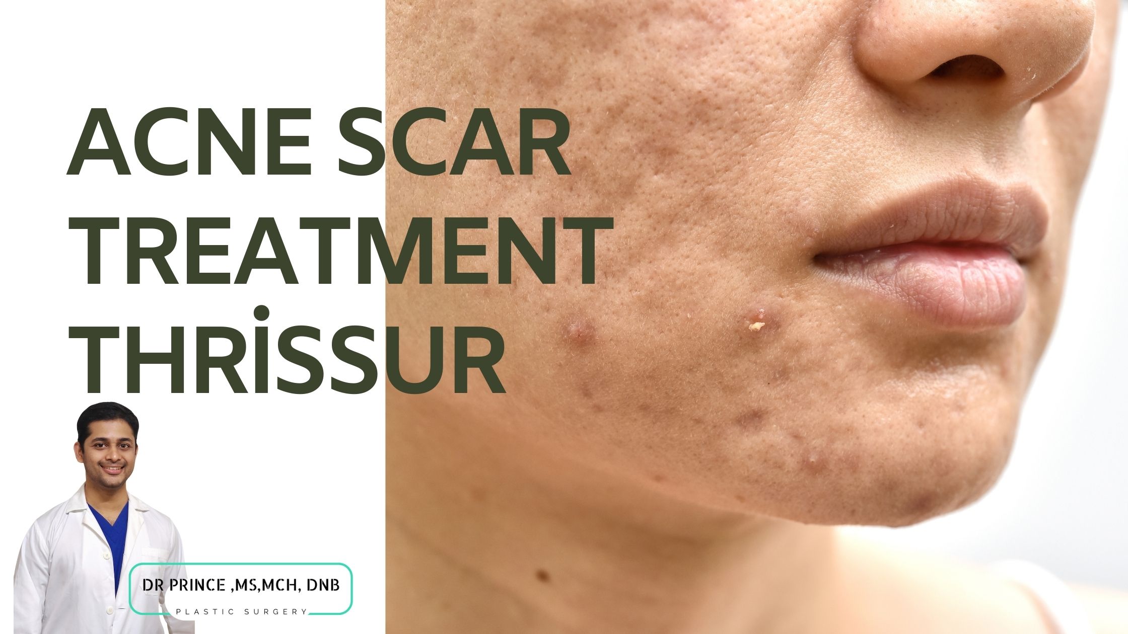 acne scar treatment thrissur