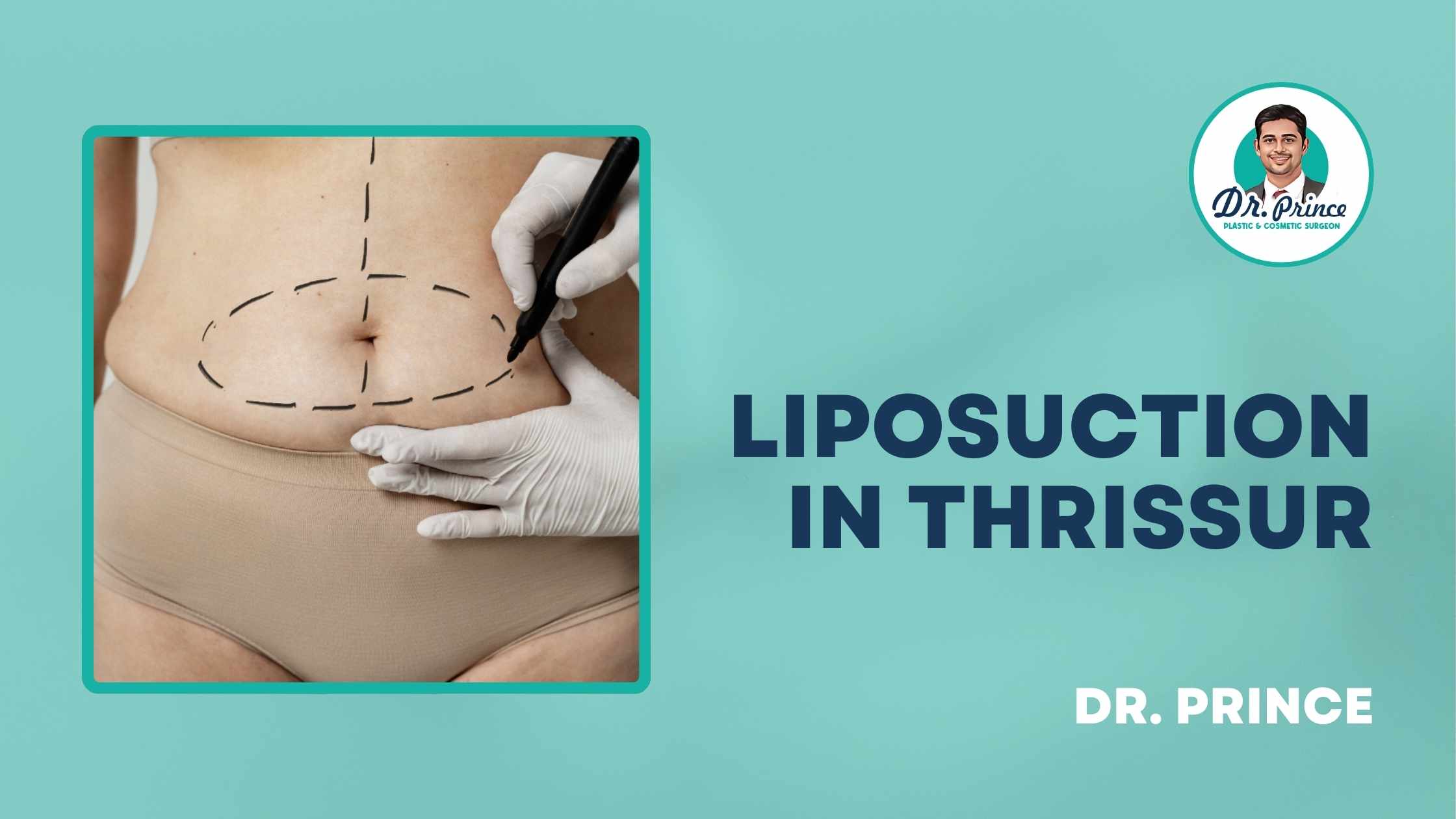 Liposuction in Thrissur by Dr. Prince at Elite Hospital