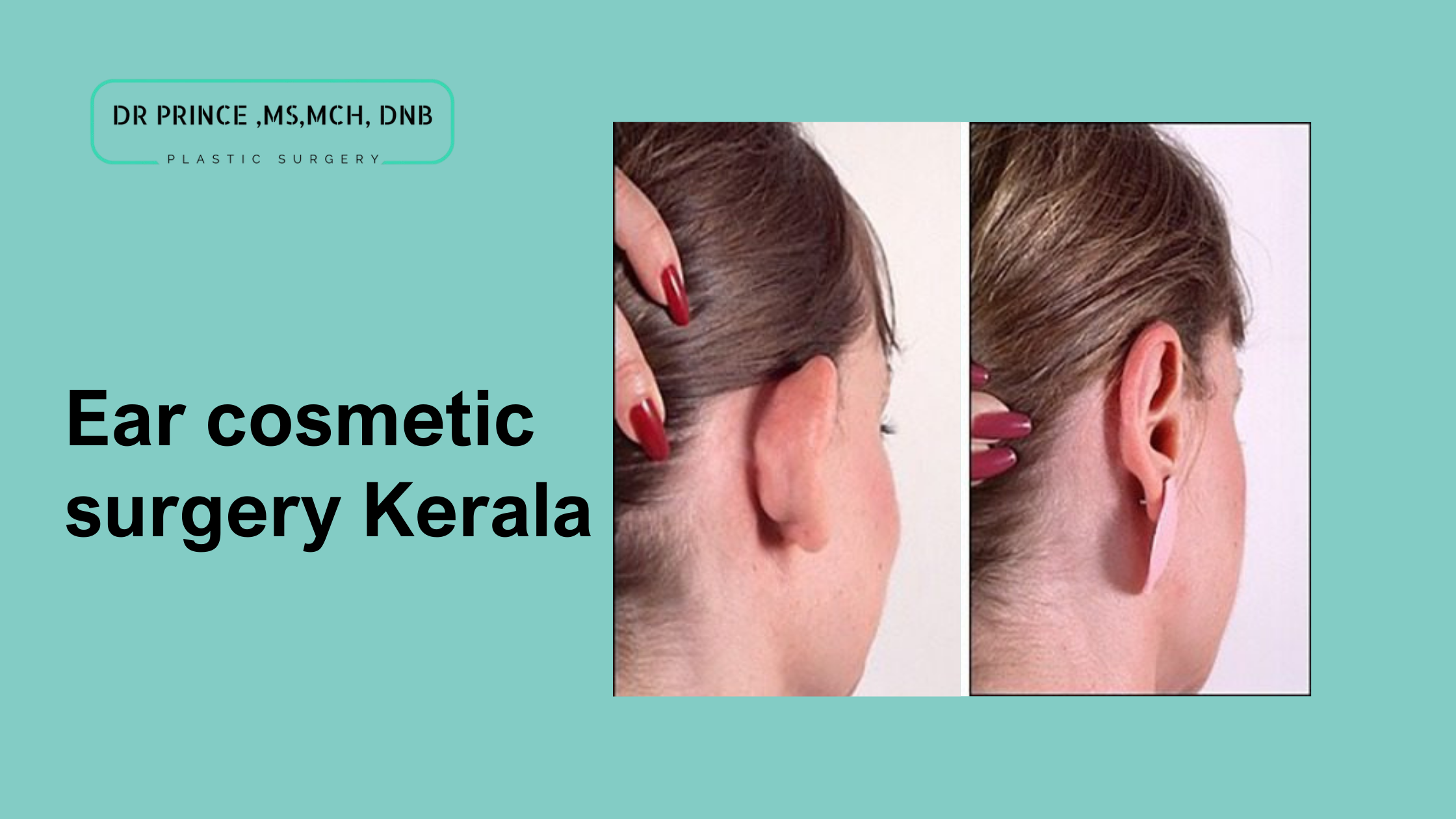 Ear cosmetic surgery procedure by Dr. Prince in Kerala, reshaping the ears for a more balanced and symmetrical appearance.