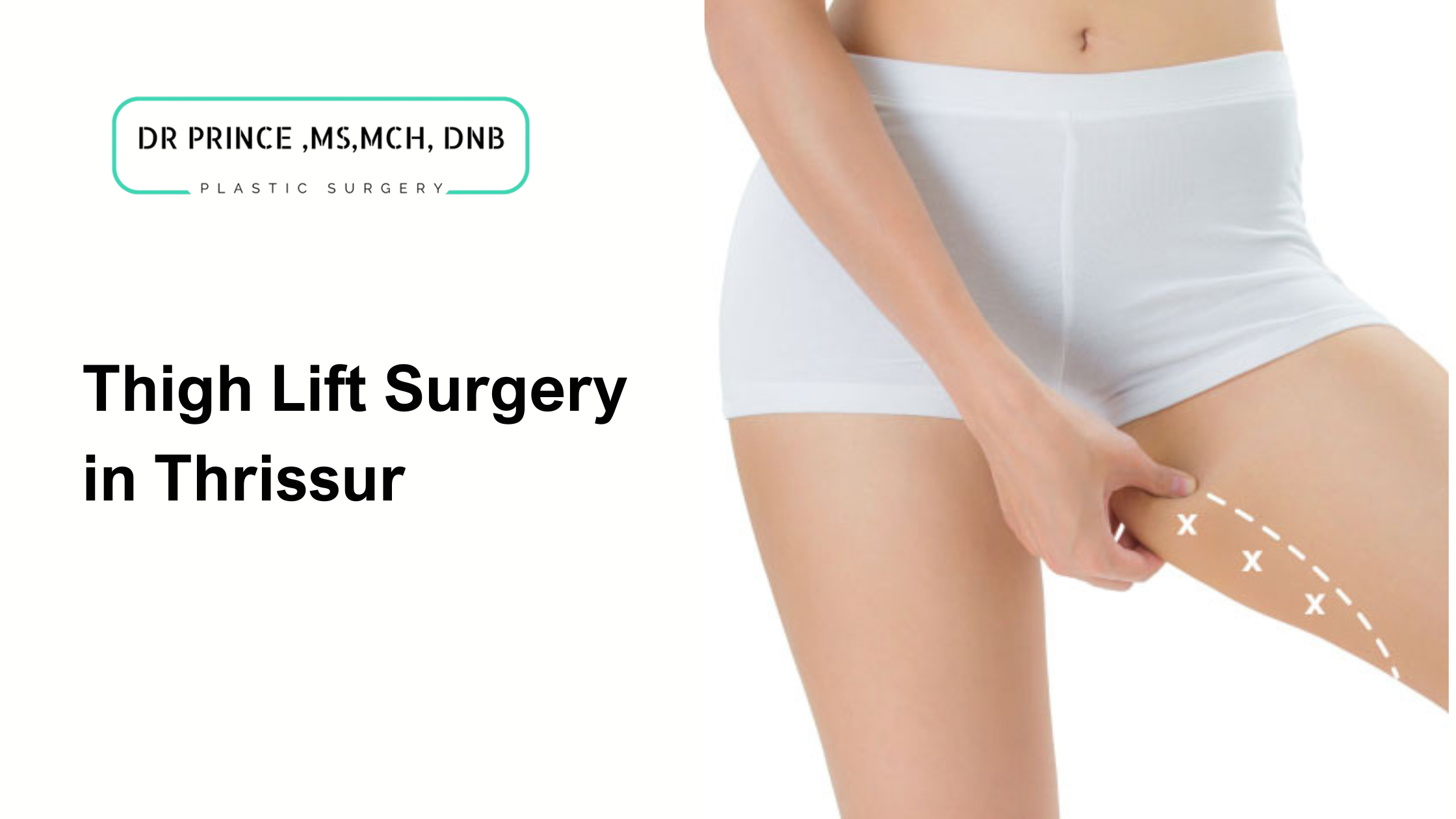 Thigh lift surgery performed by Dr. Prince in Thrissur, improving the appearance of the thighs