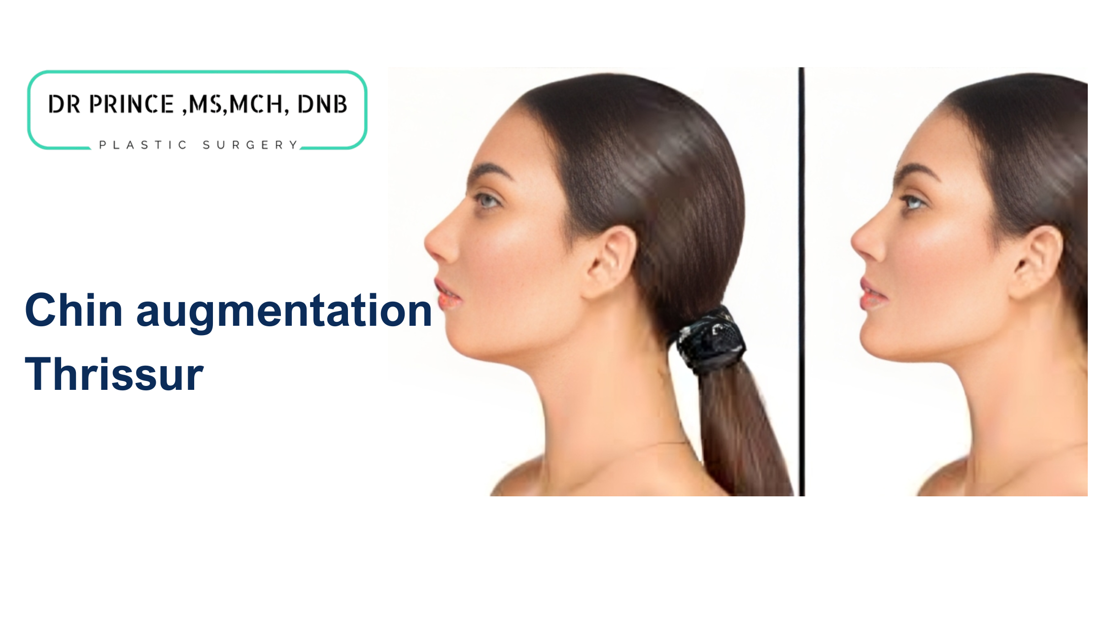 Enhance your facial aesthetics with expert chin augmentation in Thrissur. Achieve a more defined and balanced chin with Dr. Prince’s personalized approach.