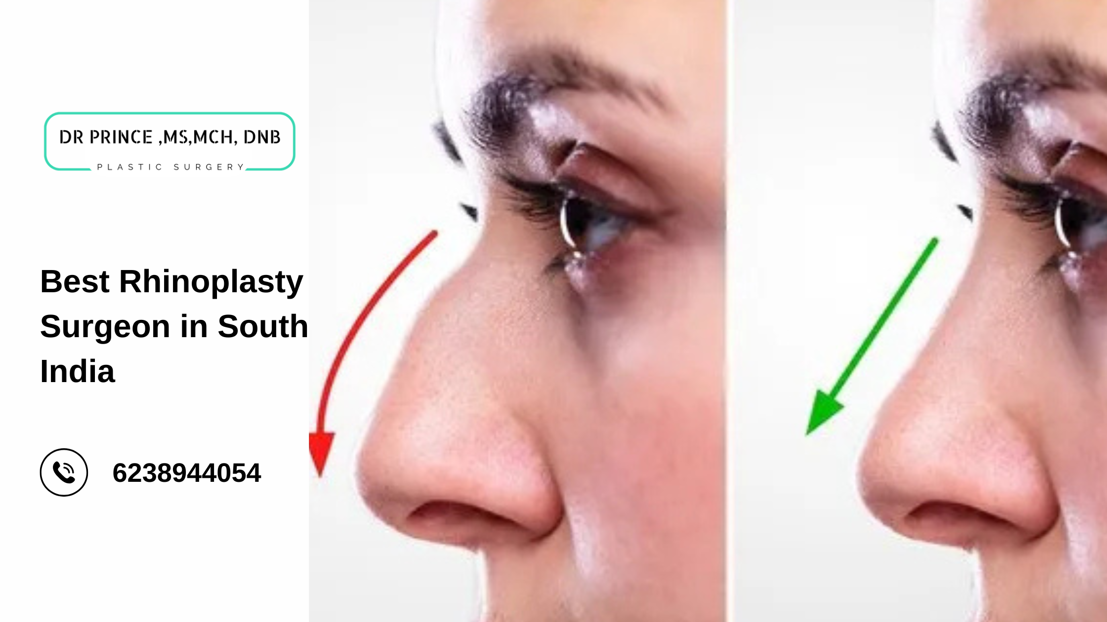 Before and after rhinoplasty results by Dr. Prince – the Best Rhinoplasty Surgeon in South India. Enhance Your Beauty with the Best Rhinoplasty Surgeon in South India – Dr. Prince’s Expert Precision!"