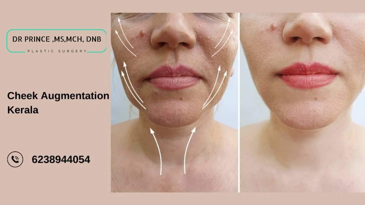 Before and after results of cheek augmentation in Kerala performed by Dr. Prince