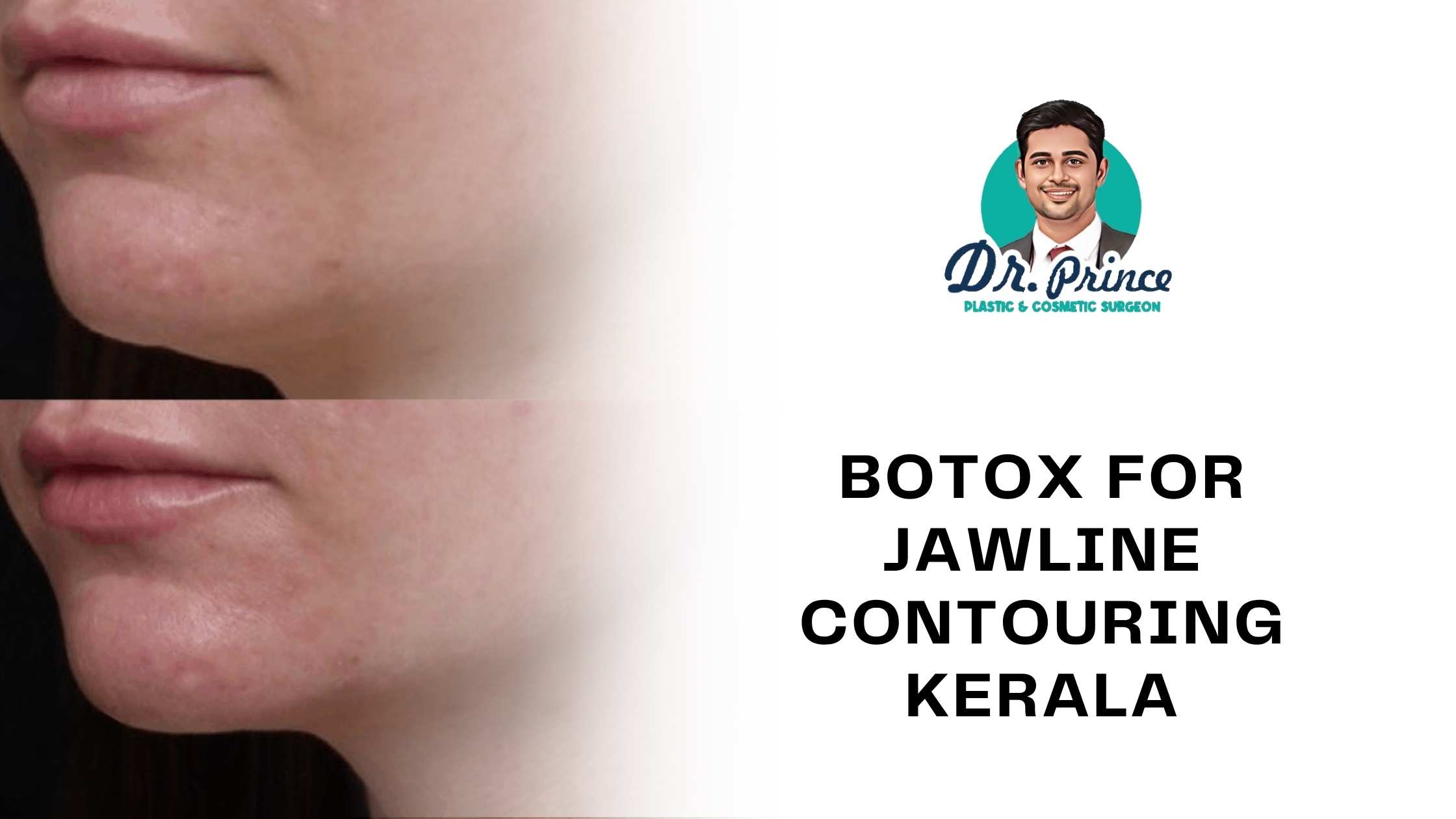 Dr. Prince performing Botox jawline contouring on a patient at his clinic in Kerala