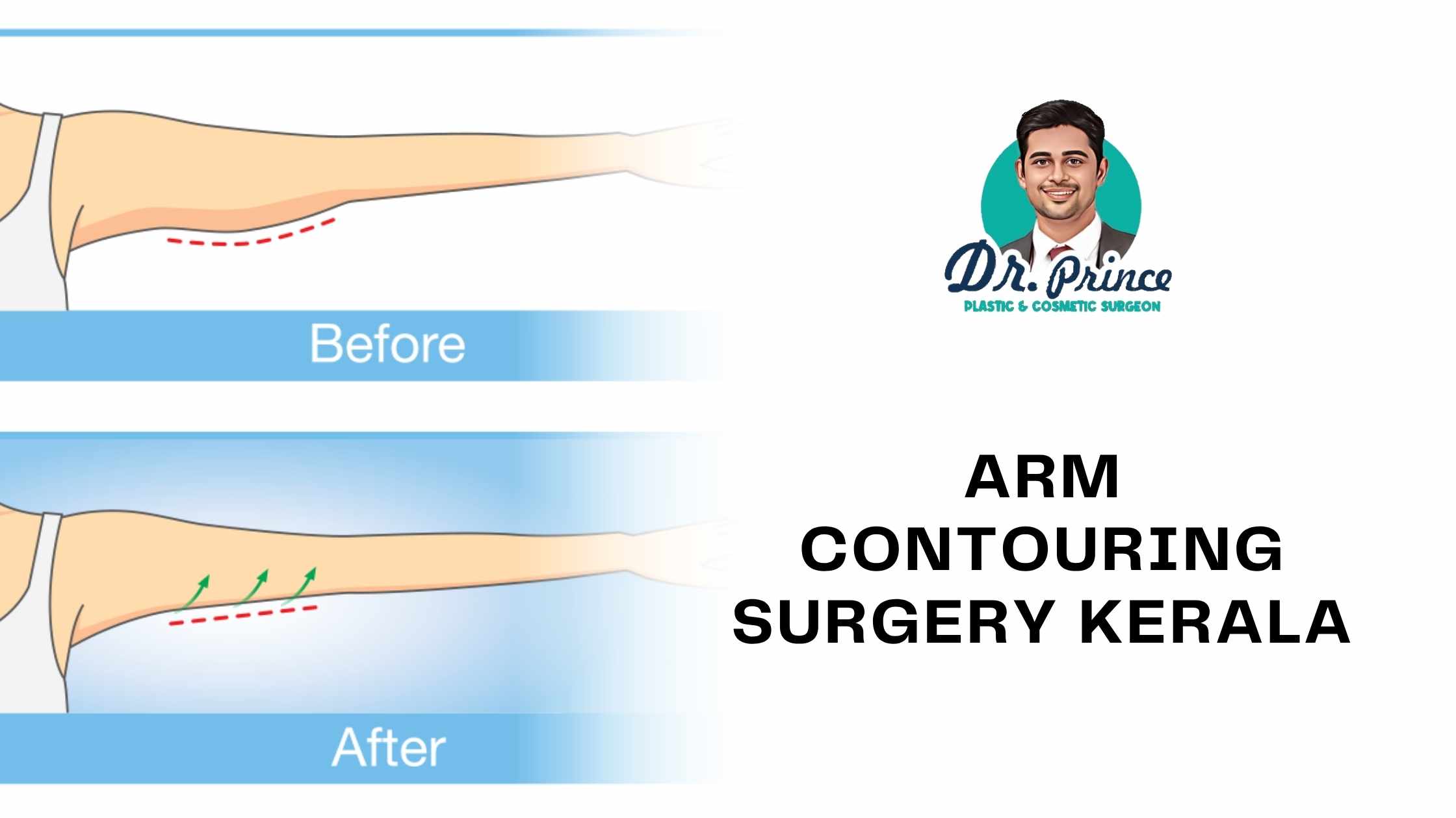 Arm Contouring Surgery in Kerala by Dr. Prince