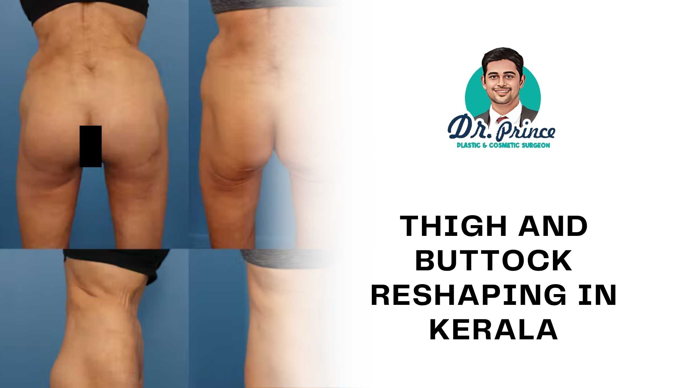 Thigh and buttock reshaping by Dr. Prince in Kerala