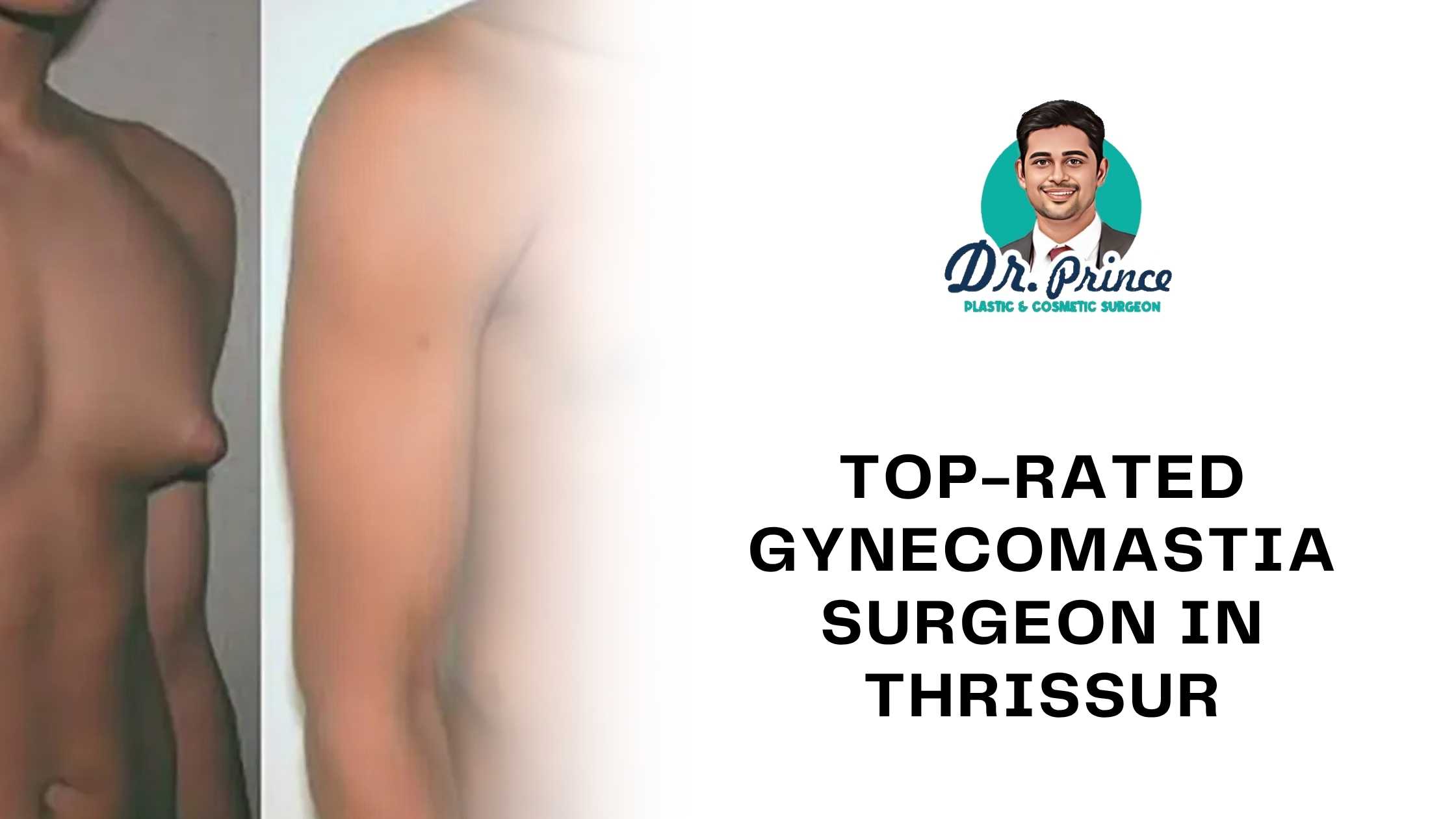 Dr. Prince examining a patient’s chest post-gynecomastia consultation at Elite Hospital, Thrissur