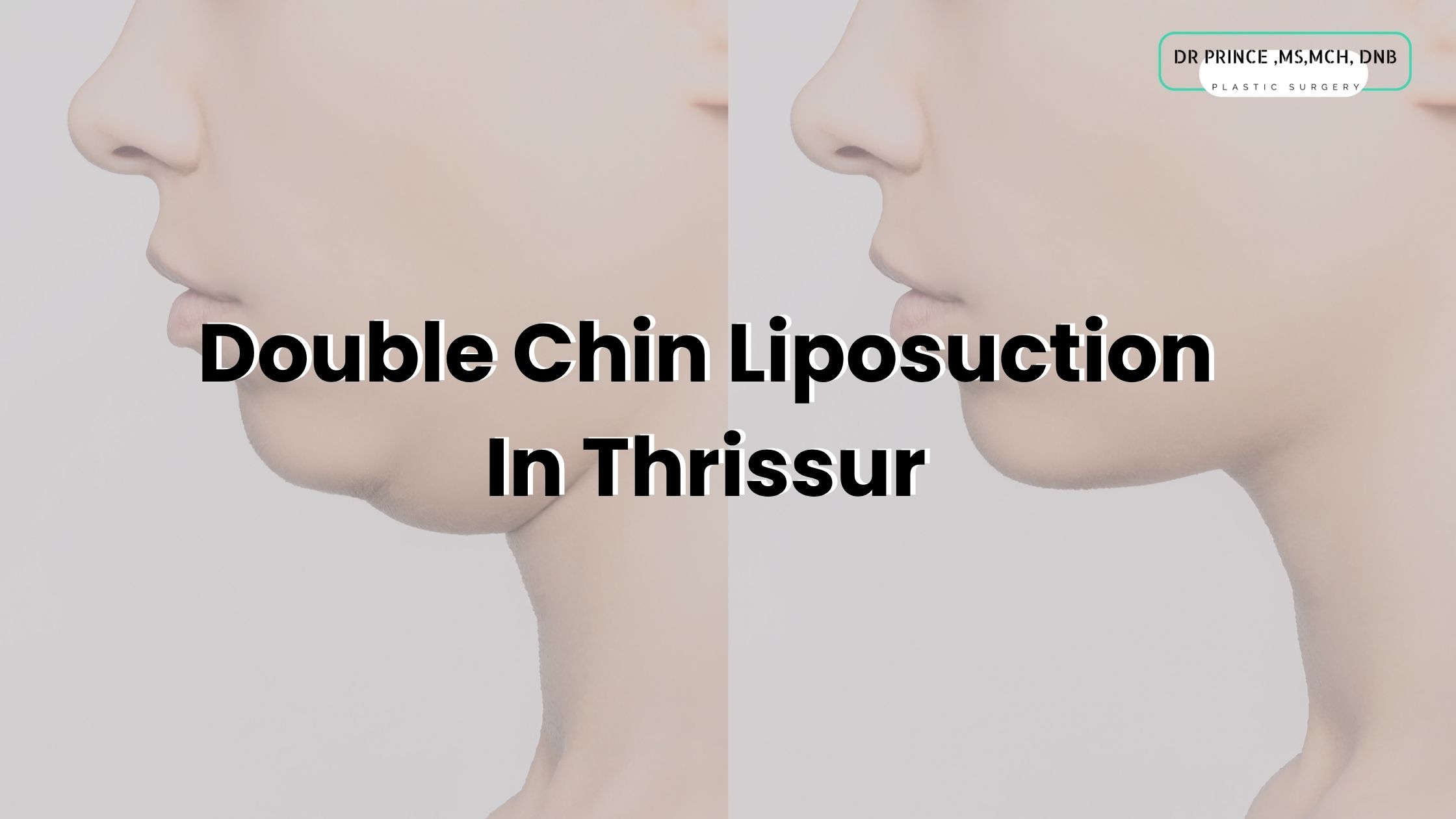 Double Chin Liposuction In Thrissur