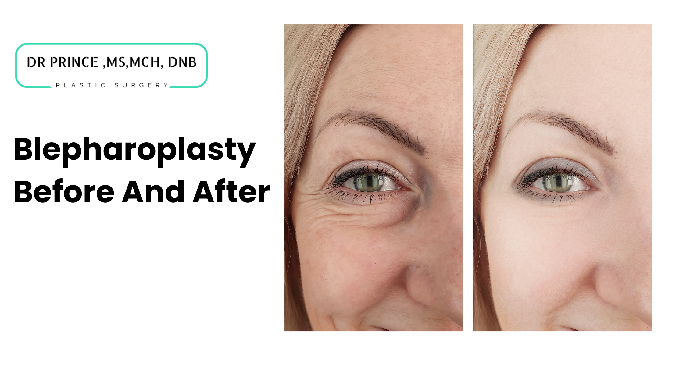 blepharoplasty before and after