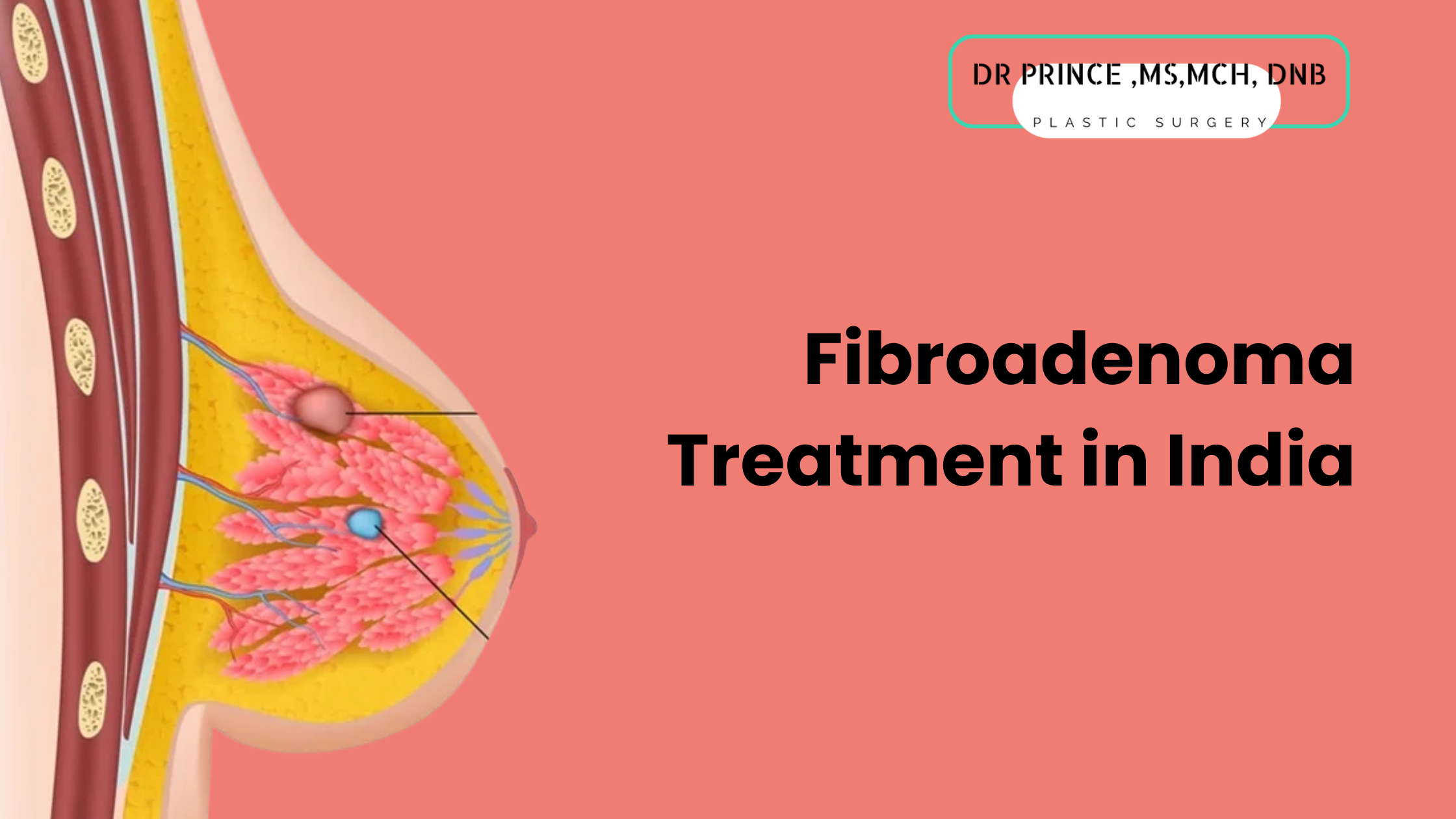 Fibroadenoma Treatment in India.
