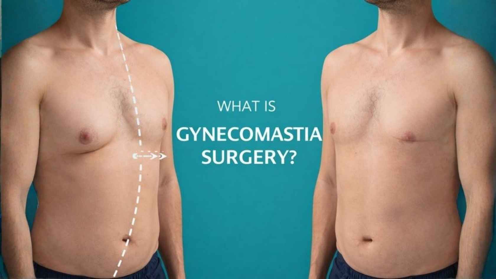 Gynecomastia surgery helps correct enlarged male breasts by removing excess glandular tissue and fat