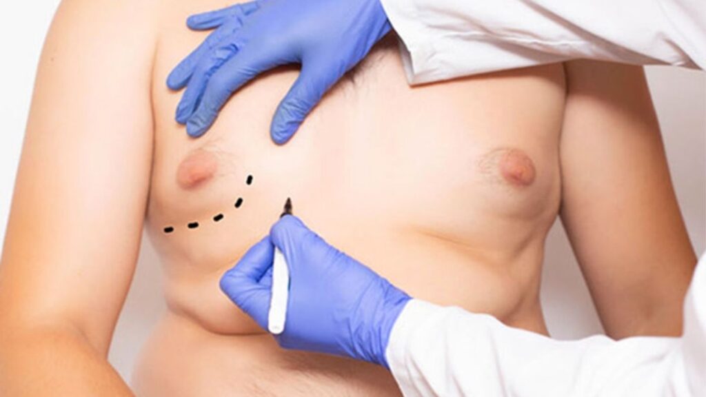 How should I prepare for gynecomastia surgery