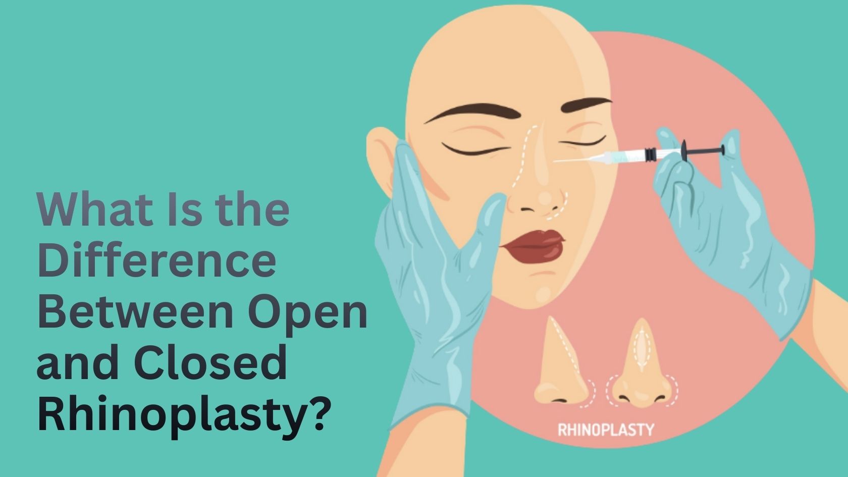 Illustration showing rhinoplasty injection planning explaining difference between open and closed rhinoplasty techniques