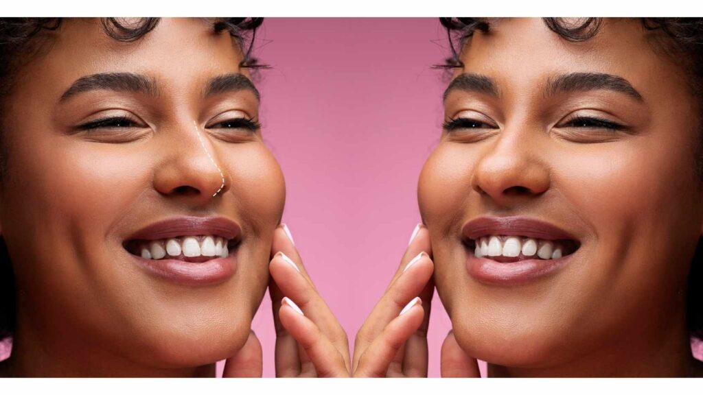 rhinoplasty before and after results