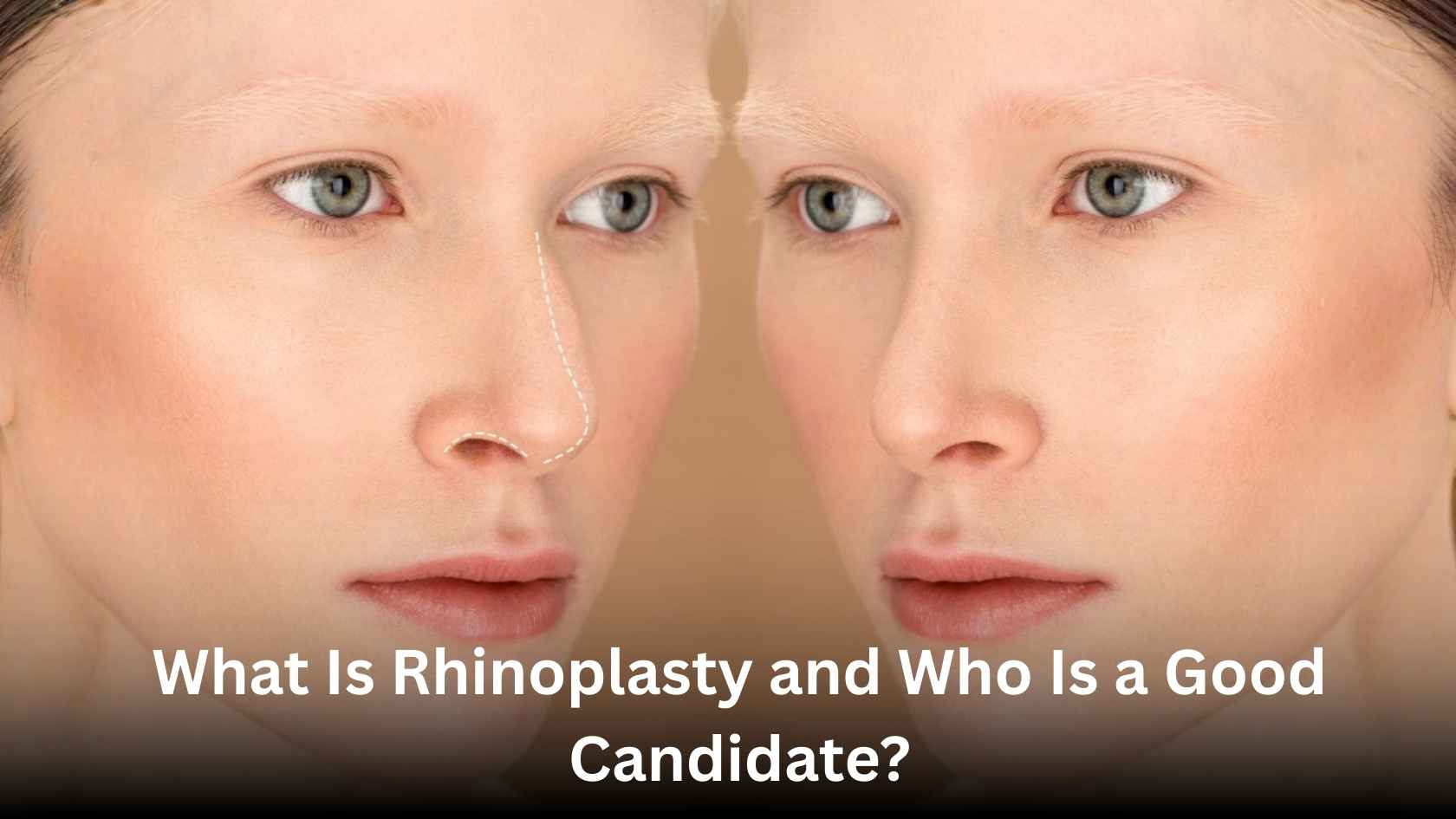 Rhinoplasty nose reshaping procedure illustrated with before and after female face comparison