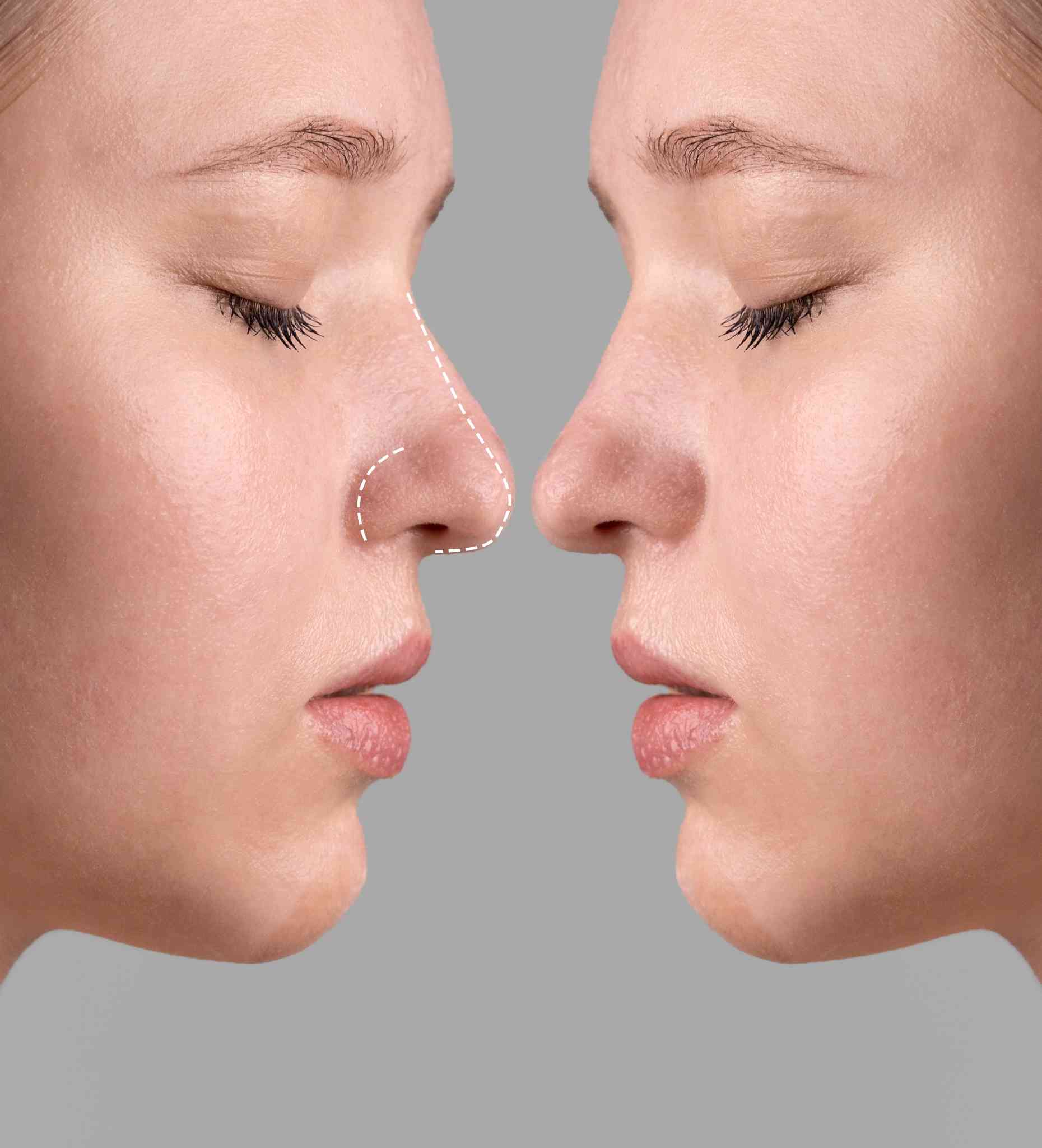rhinoplasty surgery cost consultation