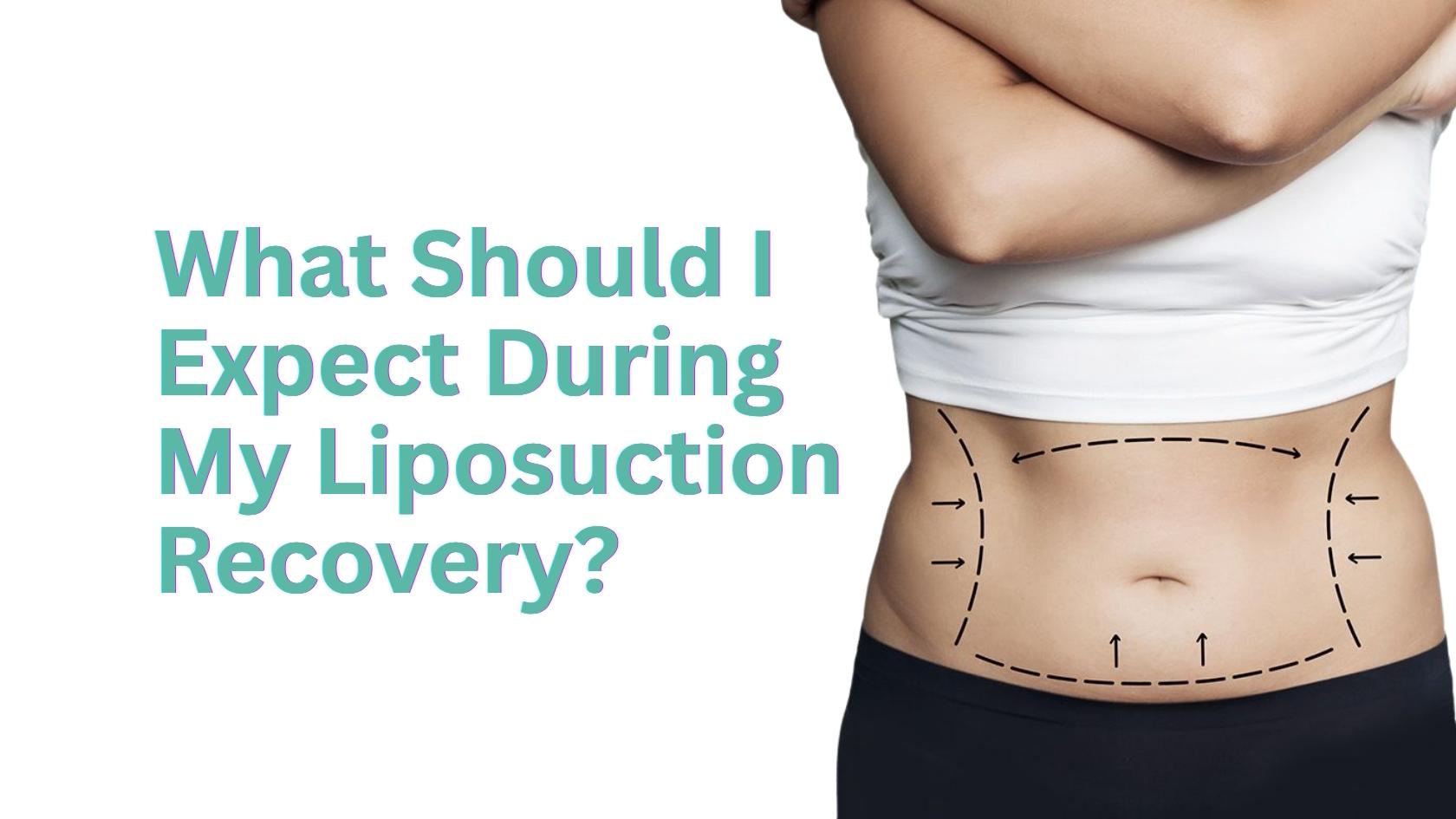Liposuction recovery process showing treated abdominal area after procedure