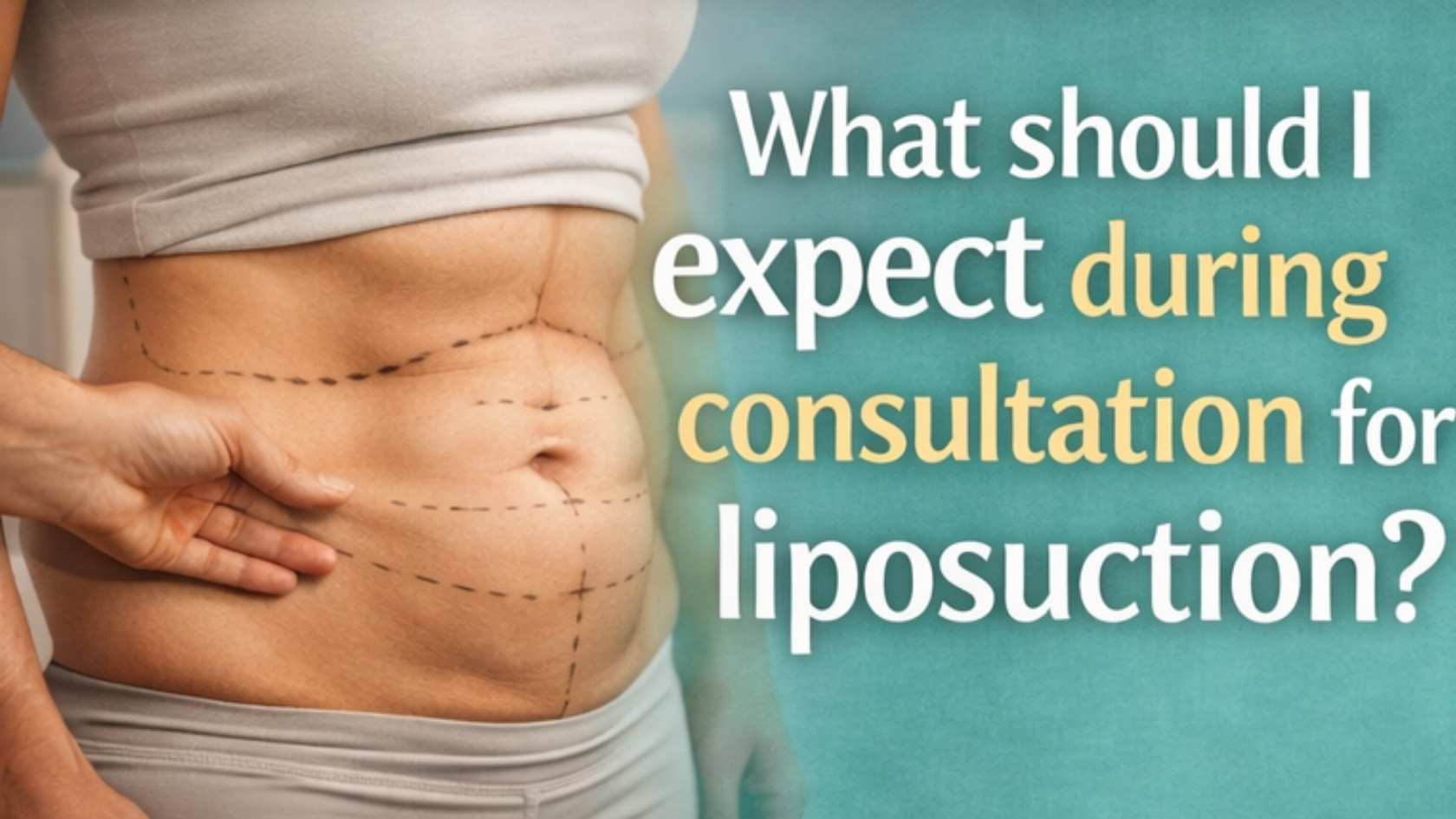 Marked abdomen showing surgical planning lines for liposuction during consultation with plastic surgeon