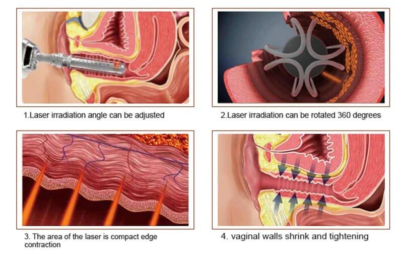 laser vaginal tightening thrissur