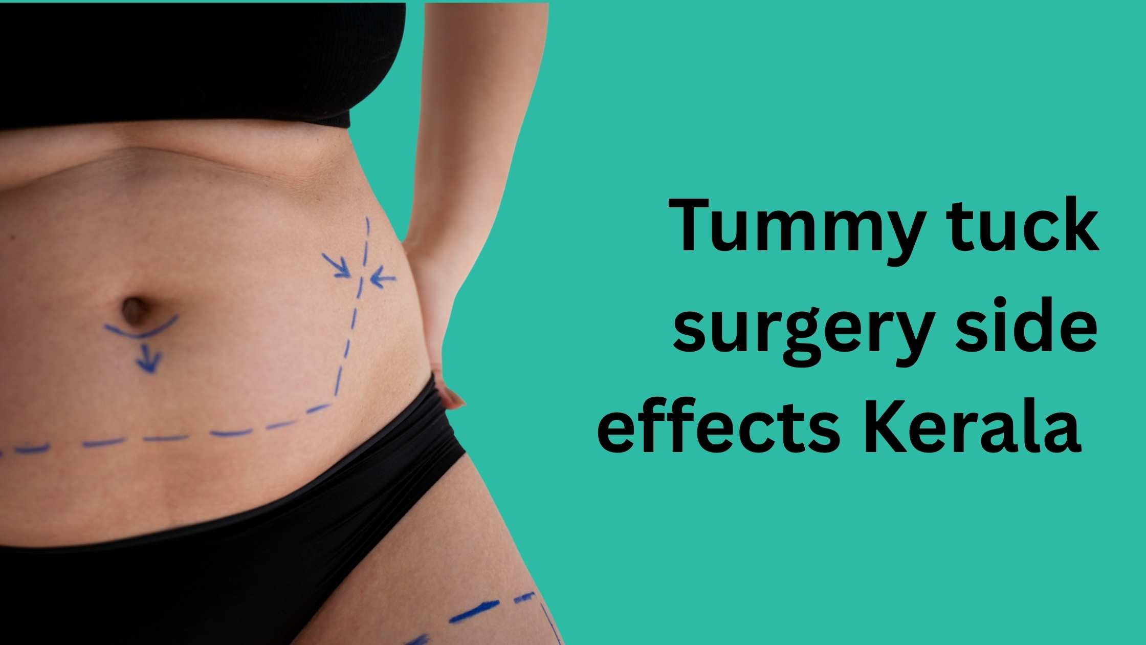 Woman abdomen markings showing Tummy tuck surgery side effects Kerala
