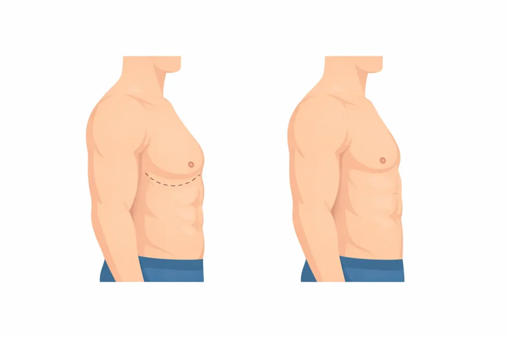 Minimal medical illustration showing before‑and‑after chest contour comparison by a gynecomastia surgeon in Kerala.