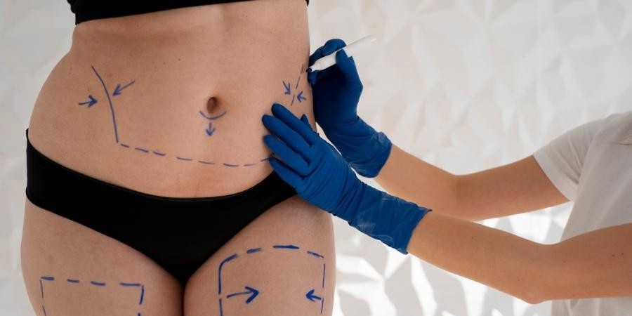 Benefits of Mommy Makeover Surgery illustrated through preoperative body contour assessment and treatment planning for post-pregnancy abdominal reshaping.