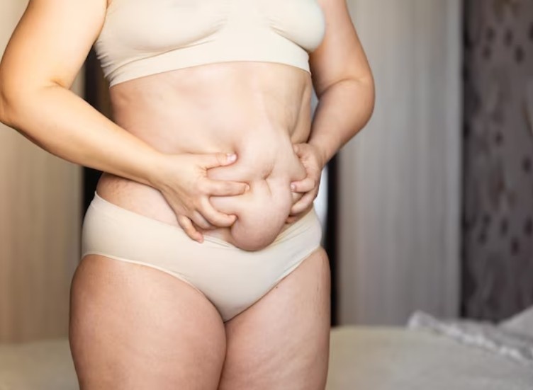 Mommy Makeover Surgery in Kerala showing post-pregnancy abdominal skin laxity and excess abdominal tissue before body contouring consultation.