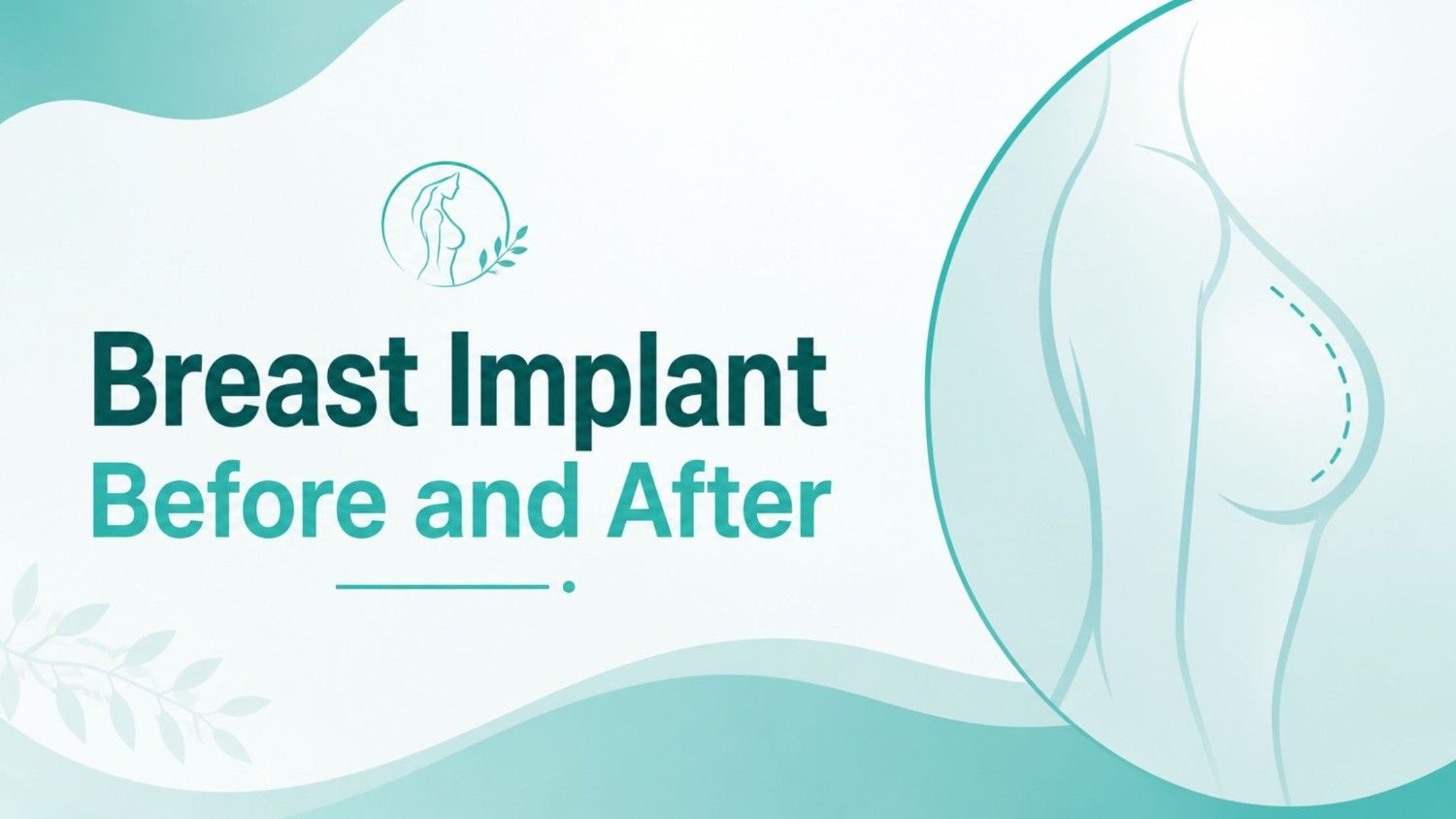 Breast Implant Before and After illustration showing the transformation from pre-surgery to natural-looking post-surgery results with balanced breast contours.