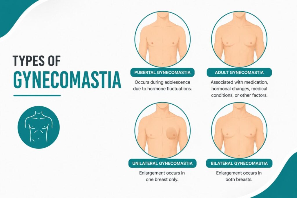 Types of Gynecomastia